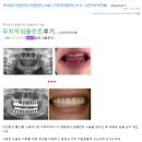 강남굿모닝치과 임플란트 시술 후기 2009. 12. 30/ 무치악 임플란트 후기