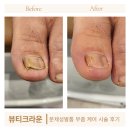 크라운 빌 | 은평구 발톱교정 무좀발톱 케어 받을 수 있는 네일샵 응암 뷰티크라운