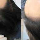 망원두피문신 점점넓어지는 M자 이마, 모발이식 말고 방법 없을까?