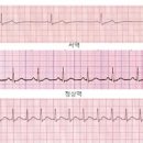 서맥 빈맥 부정맥의 원인과 증상 치료법은 있을까 이미지