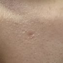한타보경한의원 | 패인 흉터, 한의원 새살침 6회차 마지막 마무리 후기 솔직한 재생 효과