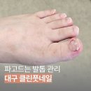 클린풋 | 대구 내성발톱 관리 파고드는 고통 케어해주는 클린풋네일 후기