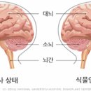 뇌사상태 뇌사판정 기준 그리고 식물인간 차이는 무엇일까 이미지