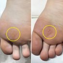 지에스25삼성언주점 | 서초동 언주역 발바닥 티눈 제거 잘하는 곳?