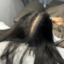 모타브 | 여성 두피문신 30대 가르마 1달 과정 SMP후기