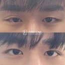 제로원성형외과의원 | 남자 눈매교정 후기, 심한 짝눈+겹쌍꺼풀 눈뜨는힘 개선 [제로원성형외과]