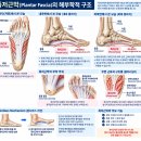 족저근막염에 K-테이프 적용하기｜발바닥 아치 지지와 운동 복귀를 위한 테이핑 이미지