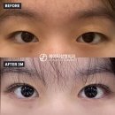 엘로이여성의원 | 얇은 쌍꺼풀 하나로 달라지는 분위기_자연유착 쌍수 후기(신사동성형외과)