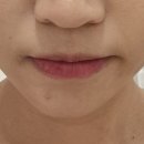 건대피부관리 피부샵추천 여드름압출 바로에스테틱