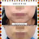 세종시인모드 리프팅레이저 후기만 믿으면 안됩니다 &lt;필독&gt;