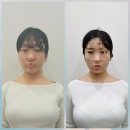 신통방통한의원 | 천호 안면비대칭교정 한의원 / 즉각적인 얼굴윤곽 개선 감동 후기