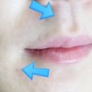 트러블 패치 새티스 쿨링 트러블 패치 후기 효과