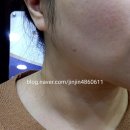 인천 쥐젖 편평사마귀 점빼기 개당 천원