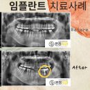 온정치과의원 | 부산 동래구 안락동치과 [온정치과의원] 임플란트 &amp; 크라운 치료 후기