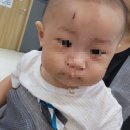 베스트병원 | [8개월 아기 이마 봉합술 후기 | 동탄 베스트아이들병원]