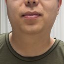 하단3-1 | 부산하단피부과 남자 턱수염 레이저제모 후기