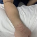 일등경희한의원 | 초등여아 아토피? 건선? 나아진 후기(노스테로이드연고, 땀내기, 천연 오일)