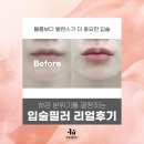 엘로이여성의원 | 신사동 피부과 입술의 구조적 특징과 디자인 포인트, 필러 전후 어떻게 바뀌었을까?