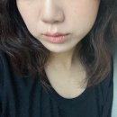 필업 | 압구정피부과 볼패임 콜라겐주사 필업 효과 후기