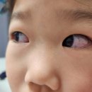 밝은아이안과의원 네이버블로그