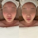 유하1 | 신창동피부관리 유하에스테틱 물방울LDM피부진정 열감내린 후기