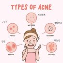 여드름[acne] 이미지