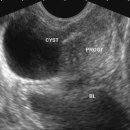 Seminal vesicle cyst 이미지