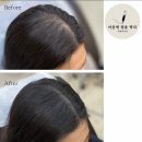 마음에점을찍다두피SMP 이미지