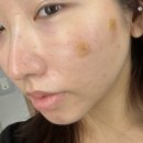 호감한의원 | 부산 장산역피부과 여드름자국치료 새살침, 포텐자+라보센 엑소좀 후기