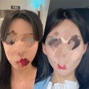 엘프귀필러 한티역 피부과 누운귀필러 후기 귀필러 통증 귀필러 가격