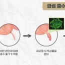 30 40대 충수암 발병 급증 원인 증상 치료 이미지