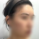 코끼리휴병원 | 이마필러시술 ㅡ부작용 통증ㅡ내돈내산솔직후기