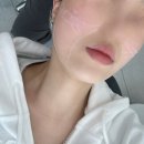 김해에서 리프팅 관리받은 후기 (리니어지 500샷 + 인모드Forma + 스킨보톡스)