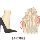 새끼발가락 통증 원인 5가지 및 치료 : 소건막류 골절 휨 부음 티눈 이미지