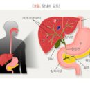 담석증 원인 및 , (통증, 수술) 이미지