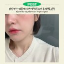 폴리한의원 | 강남 피부과/한의원 : 건조한 겨울철 피부관리 시술 1등은? PN연어부스터 솔직후기