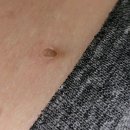 산성믿음약국 | 쥐젖 제거 연고 후기 관리 실패 후 얻은 생활 tip