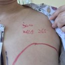 재건 | 재건 수술 후기 1 - 수술 당일