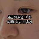 벨약국 | [강남 벨포인트의원] 강남 주근깨 레이저 4개월 후 솔직 경과: 내돈내산 리얼 후기 2탄