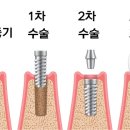 하이플란트치과 네이버블로그