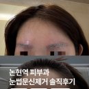아름다운피부과의원 | 논현역 피부과 더아름다운의원 눈썹문신제거 솔직후기