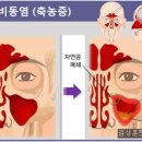 알레르기성 비염, 축농증 치유 이미지