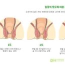 치핵 종류 내치핵 외치핵 혼합치핵 원인 증상 검사 수술 치료 1기 2기 3기 4기 이미지