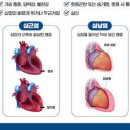 심장 통증 심낭염 심근염 이미지