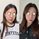 압구정찜질방사우나 | 압구정역피부과 인모드 fx + 포마 후기 (통증, 전후비교)