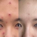 역삼약국 | 강남 역삼피부과 이마, 미간흉터 제거 새살침 1회차 일주일 결과 내돈내산 후기