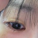 닥터김메디코스의원 | 닥터아이씨엘안과의원 렌즈삽입술 후기(2) 수술~회복