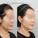 빌리프성형외과 네이버블로그