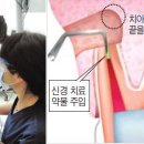 "임플란트를 왜 해?" 40분이면 치료 끝 ＜치근단 절제술＞ 이미지