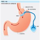 신해철 사인 논란 "위 밴드 수술" 뭐길래(매경 e신문) 이미지